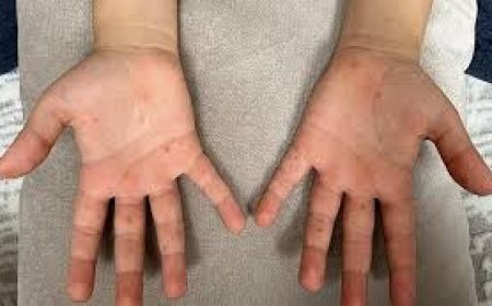 Çocuk Hastalığı Sanılıyor, Ancak Yetişkinlerde de Görülüyor: El, Ayak, Ağız Hastalığına Karşı Önlemler