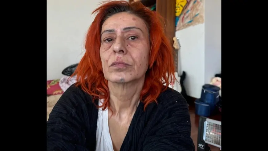 Yıldız Tilbe saç boyası nedeniyle kimyasal yanık oldu! Son halini paylaştı