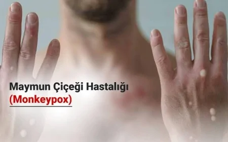 Maymun Çiçeği Virüsü: Son Durum ve Önlemler