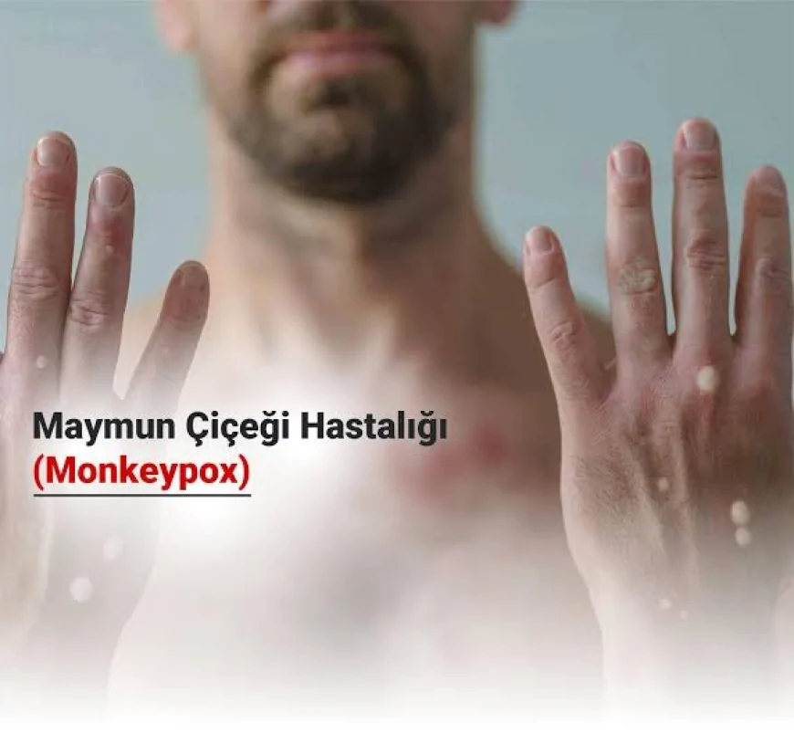 Maymun Çiçeği Virüsü: Son Durum ve Önlemler