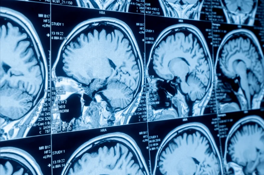 Michigan Üniversitesi Geliştirdiği Yapay Zekâ Sistemiyle Beyin MR Görüntülerini Saniyeler İçinde Analiz Ediyor