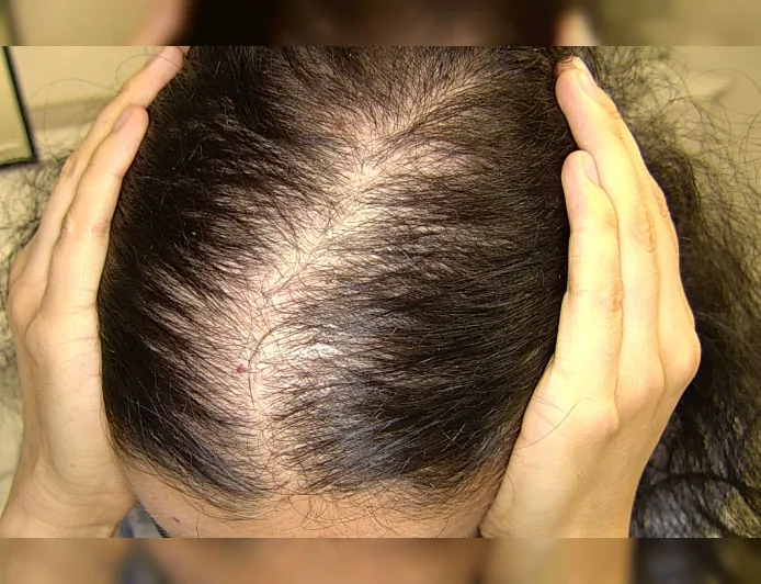 Prof. Dr. Ayşe ÇARLIOĞLU, hormonal nedenlerin saç dökülmesindeki kritik rolünü ve multidisipliner tedavi yaklaşımını anlattı