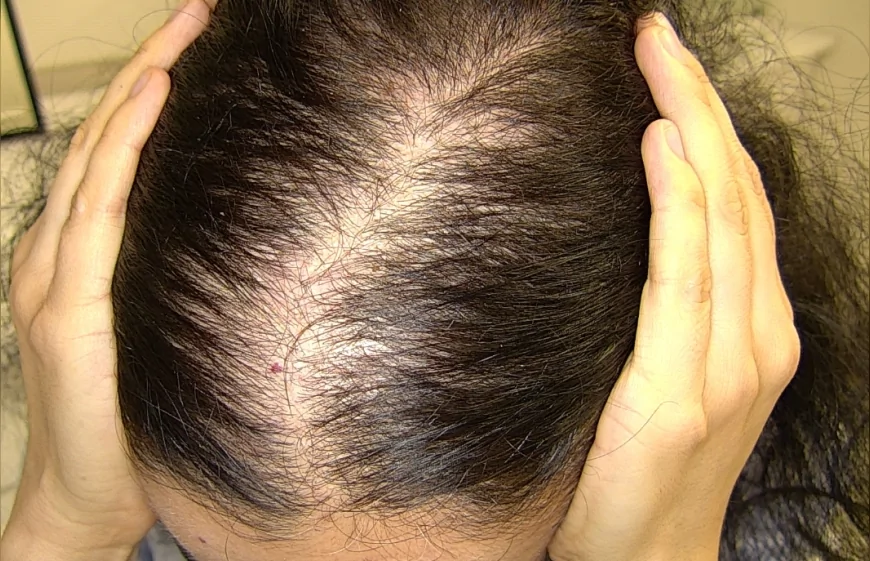 Prof. Dr. Ayşe ÇARLIOĞLU, hormonal nedenlerin saç dökülmesindeki kritik rolünü ve multidisipliner tedavi yaklaşımını anlattı